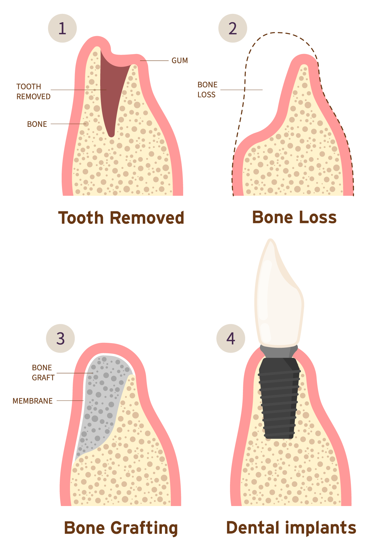 Bone Grafting in Renton
