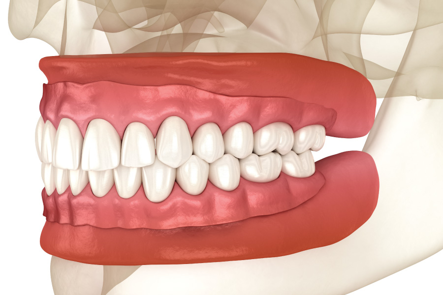 Renton Full Dentures