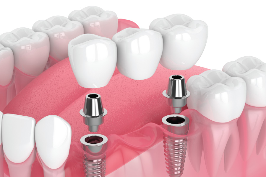 Renton Implant-Supported Bridges