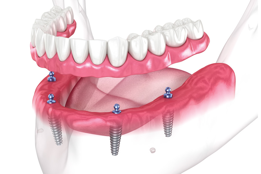 Renton Implant-Supported Dentures