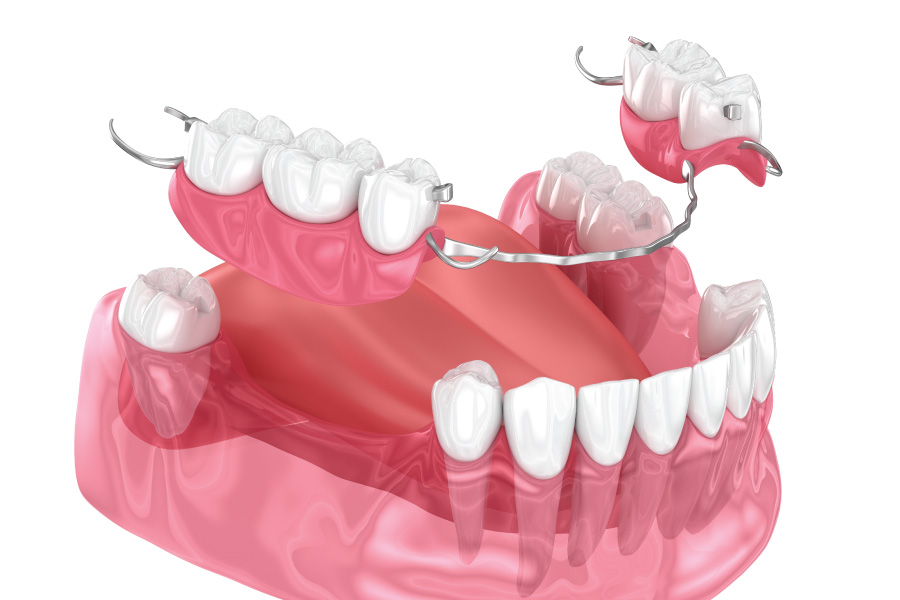 Renton Partial Dentures