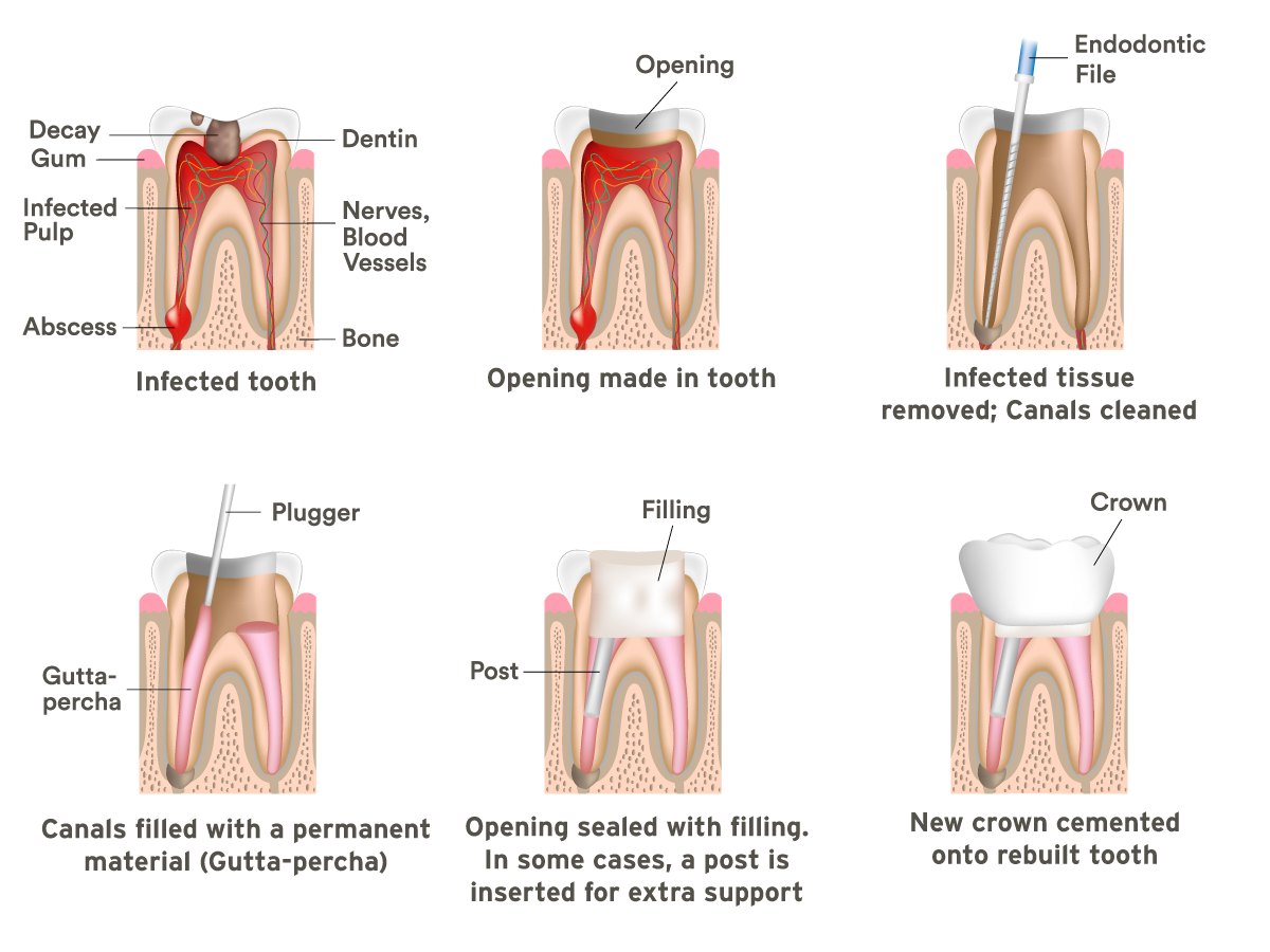 Renton Root Canals